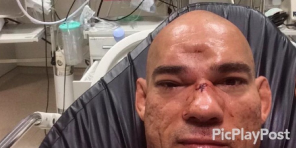 Evangalista 'Cyborg' Santos loopt horrorblessure op